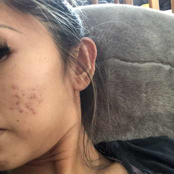 Chantik, Skin and Permanent Makeup - Scarring from acne. - Skin Care Near Me - Diamond Bar, California