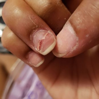 J&R Nail Spa - My damaged nail from them trying to remove nail extensions - Nail Salons Near Me - Mohegan Lake, New York J&R Nail Spa - My damaged nail from them trying to remove nail extensions - Nail Salons Near Me - Mohegan Lake, New York