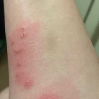 Junius Ponds Cabins & Campground - Allergic reaction to bed bugs - Campgrounds Near Me - Phelps, New York Junius Ponds Cabins & Campground - Allergic reaction to bed bugs - Campgrounds Near Me - Phelps, New York