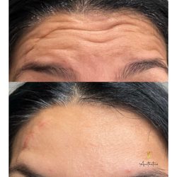 JT Aesthetics - BOTOX