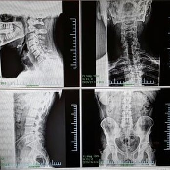 Lake Stevens Chiropractic - Chiropractors Near Me - Lake Stevens, Washington