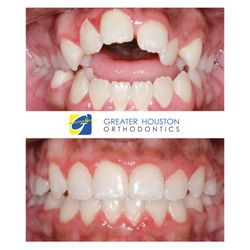 Greater Houston Orthodontics - Open bite correction. No surgery needed!
