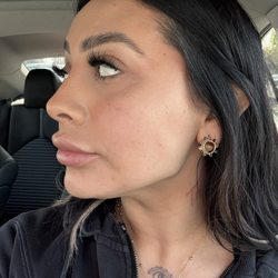 NakedMD - Post cheek & jawline