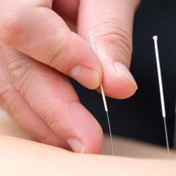 Northwest Indiana Acupuncture and Massage