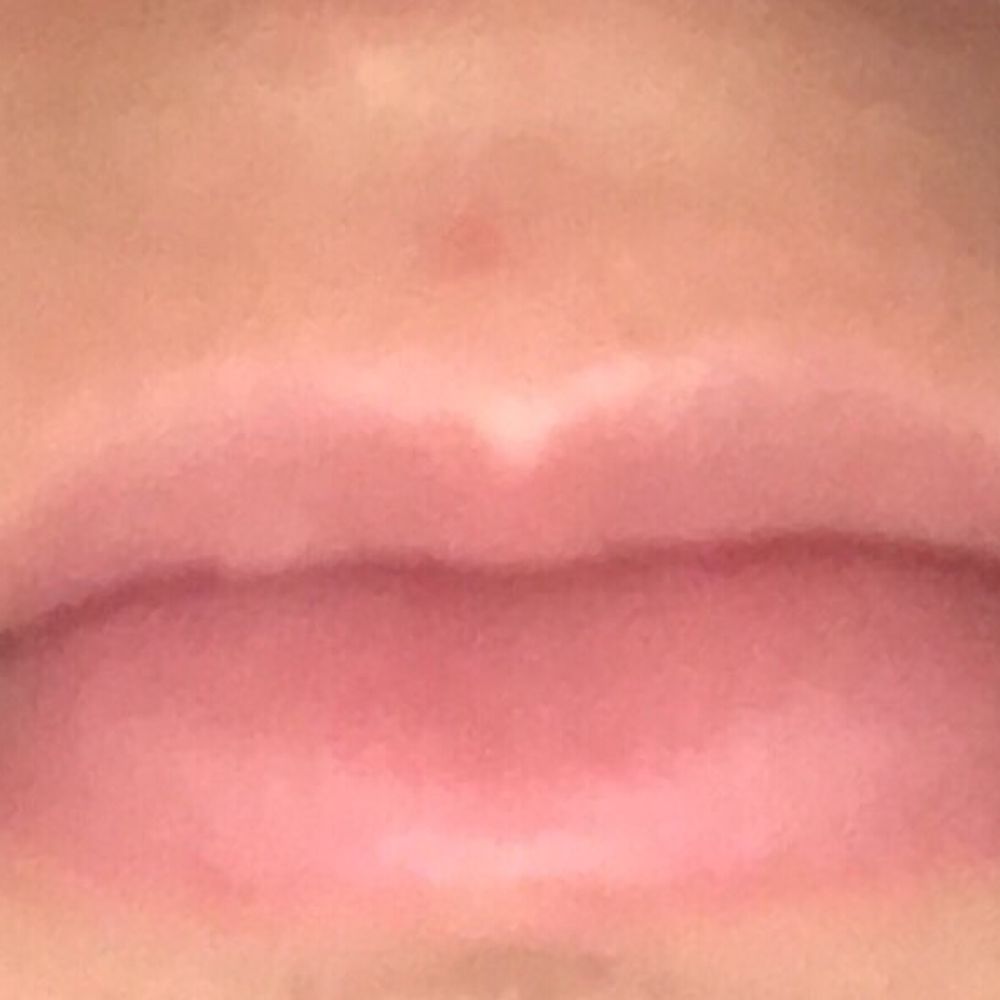 Impressions MedSpa - Before my first visit for Juvederm this year. - Laser Hair Removal Near Me - Fairfax, Virginia Impressions MedSpa - Before my first visit for Juvederm this year. - Laser Hair Removal Near Me - Fairfax, Virginia