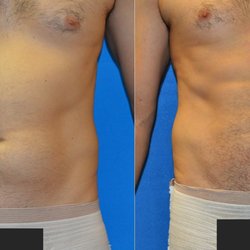Silhouette Body Sculpting - Midsection fat removal, with abdominal sculpting