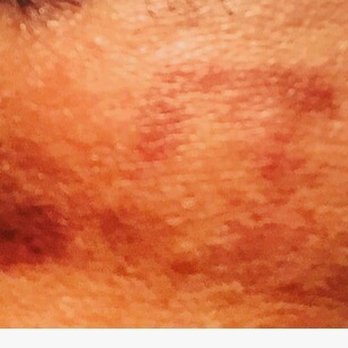 Vancouver Star Laser Centre - 2 months later scars & 2nd degree burns from "Dr. Shraham"  my GP confirmed it's NOT going to heal - Skin Care Near Me - Burnaby, British Columbia