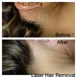 Laser Derm Med Spa - Pain free laser hair removal