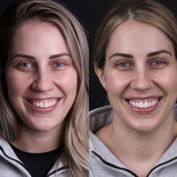 VINO Smiles Dentistry - Porcelain veneers