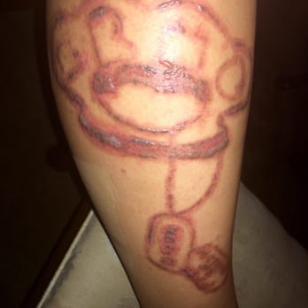 Marta Recasens MediSpa - After first treatment , some blistering - Tattoo Removal Near Me - Glendale, California Marta Recasens MediSpa - After first treatment , some blistering - Tattoo Removal Near Me - Glendale, California