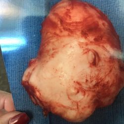 Revana Lukman, MD - Fibroid tumor that was removed from my uterus