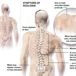Raindrop Technique Massage By Bonnie - Raindrop technique works wonders for scoliosis!