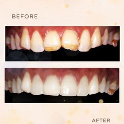 La Jolla Cosmetic Dentistry and Orthodontics - Composite Veneers
