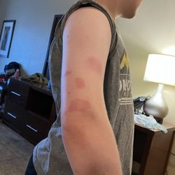 Son's arm covered in flea bites