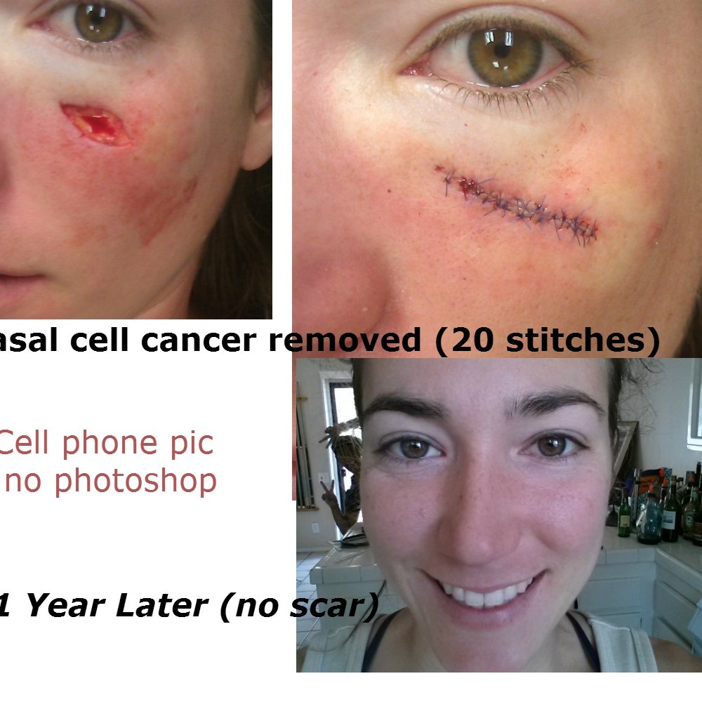 Dr Samireh Z Said - Dr. Said was surprised but let me take a cell phone pic for my documents. Before and after one year apart, 'nuf Said:P I'm happy - Dermatologists Near Me - Tustin, California Dr Samireh Z Said - Dr. Said was surprised but let me take a cell phone pic for my documents. Before and after one year apart, 'nuf Said:P I'm happy - Dermatologists Near Me - Tustin, California
