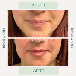 Abloom Med Spa - Rejuvenating lips