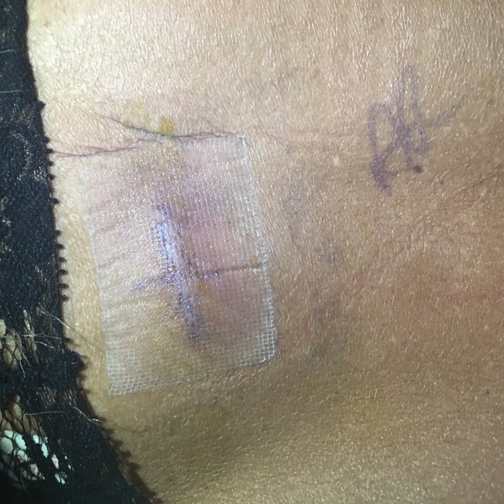 Comprehensive Spine Institute - Look how small incision is! Less time to recover - Orthopedists Near Me - Clearwater, Florida