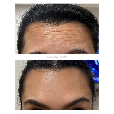 Botox/Jeuveau/Xeomin - When Tox is injected strategically and while keeping anatomy in mind, the results can be quite natural and long-lasting. The most common areas of treatment with tox is the forehead, between the brows, the crows feet, and for a brow lift. We also use tox to help with TMJ pain/facial slimming, lip flip, gummy smile correction, and hyperhidrosis (excessive sweating). Botox/Jeuveau/Xeomin - When Tox is injected strategically and while keeping anatomy in mind, the results can be quite natural and long-lasting. The most common areas of treatment with tox is the forehead, between the brows, the crows feet, and for a brow lift. We also use tox to help with TMJ pain/facial slimming, lip flip, gummy smile correction, and hyperhidrosis (excessive sweating).