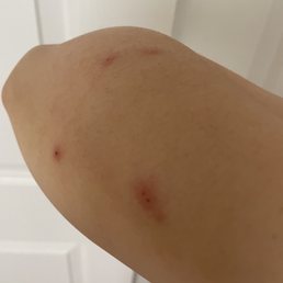 Bed bug bites