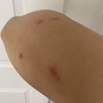Hampton Inn Ridgefield Park - Bed bug bites - Hotels Near Me - Ridgefield Park, New Jersey