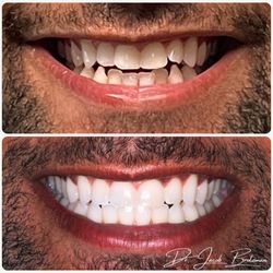 Restoration Dental - Invisalign treatment