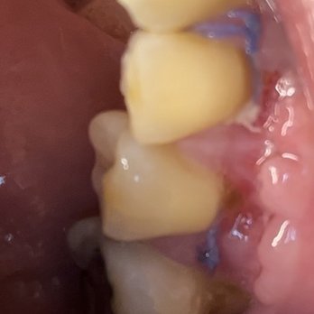 Southern Smiles Dental Studio - Failed gum graft. They said it's fine. Outside periodontist said omg & put me on antibiotics. - General Dentistry Near Me - Columbia, South Carolina Southern Smiles Dental Studio - Failed gum graft. They said it's fine. Outside periodontist said omg & put me on antibiotics. - General Dentistry Near Me - Columbia, South Carolina