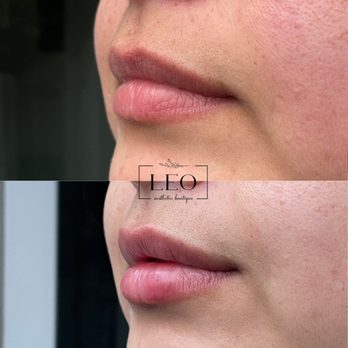 Leo Aesthetics Boutique - Subtle lip enhancement - Medical Spas Near Me - Granite Bay, California Leo Aesthetics Boutique - Subtle lip enhancement - Medical Spas Near Me - Granite Bay, California