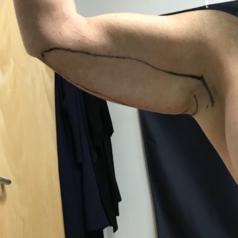 San Diego Body Contouring - Before surgery. - Cosmetic Surgeons Near Me - San Diego, California San Diego Body Contouring - Before surgery. - Cosmetic Surgeons Near Me - San Diego, California