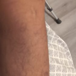 Catherine M Robertson, MD - She's Great Smaller Scar than Others I meet