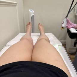 Laser hair removal