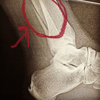 Rivergate Skate Center - My fractured bone. - Skating Rinks Near Me - Madison, Tennessee