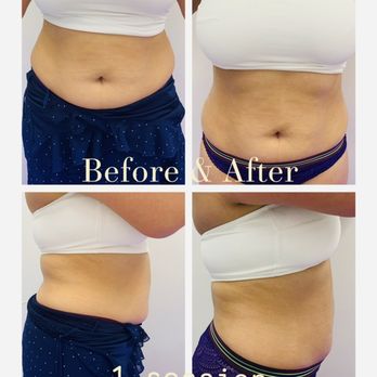 Tialli Bellá - Body Fat Cavitation, before and after. - Body Contouring Near Me - Alexandria, Virginia Tialli Bellá - Body Fat Cavitation, before and after. - Body Contouring Near Me - Alexandria, Virginia