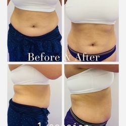 Tialli Bellá - Body Fat Cavitation, before and after.