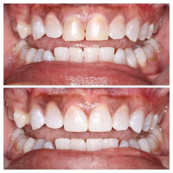 Michelle Chan, DDS - Bonding replacement - Cosmetic Dentists Near Me - New York, New York Michelle Chan, DDS - Bonding replacement - Cosmetic Dentists Near Me - New York, New York