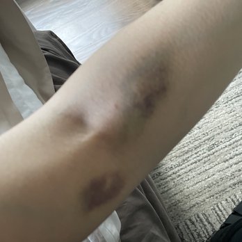 Bergen Medical Associates - Bruises post blood draw. - Medical Centers Near Me - Ridgewood, New Jersey Bergen Medical Associates - Bruises post blood draw. - Medical Centers Near Me - Ridgewood, New Jersey