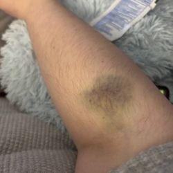 Labcorp - Bruising from extremely painful blood draw on 12/08/225; persistent discomfort continues as of 3/2/26.