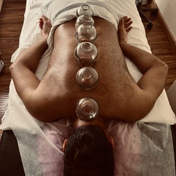 WL Wellness - Cupping in the back - Acupuncture Near Me - San Jose, California