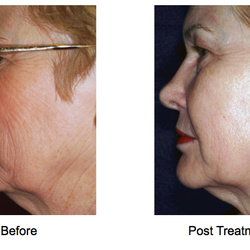 Laser of Arlington - Fine Lines & Skin Tightening Before and After