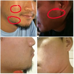 Mole Removal by Lina Mole Removal by Lina