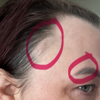 Rouge Medical Spa - 3 hours later :( - Medical Spas Near Me - Sacramento, California Rouge Medical Spa - 3 hours later :( - Medical Spas Near Me - Sacramento, California