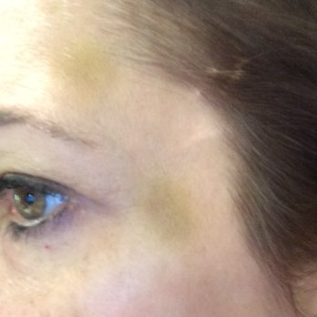 Adara Aesthetics - Bruising from Botox treatment at Adara. Visible for over one week. - Medical Spas Near Me - Houston, Texas