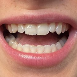 Smiley Dental - Beverly - Chipped Teeth