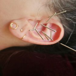 Keystone Acupuncture & Chinese Medicine  - Some ear acupuncture for fatigue, insomnia, and auto immune support.
