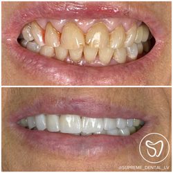 Supreme Dental - Smile makeover with veneers, crowns & laser gum treatment to reduce gummy smile. Restored upper/lower 8 teeth (Level II).