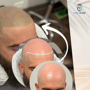 Cool Scalp - Hair Loss Centers Near Me - Irvine, California Cool Scalp - Hair Loss Centers Near Me - Irvine, California