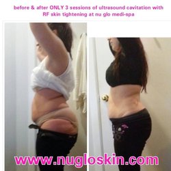 Nu Glo Skin & Laser Spa - Before/After ONLY 3 sessions of CaviLipo w/RF Skin Tightening
