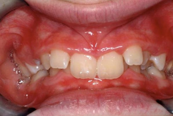 Case 1 - This patient had a Class II with a severe deep overbite. Case 1 - This patient had a Class II with a severe deep overbite.