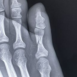Fractured pinky toe. Amazing and fast process.