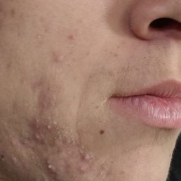 Prior to facial and skin routine
