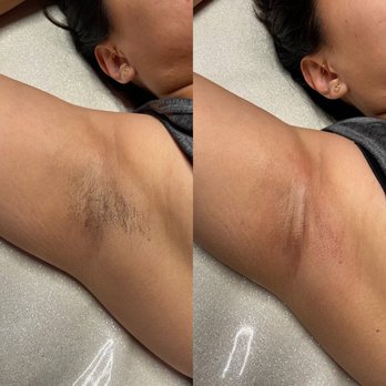 Skin Dulce - Underarm sugaring - Estheticians Near Me Skin Dulce - Underarm sugaring - Estheticians Near Me